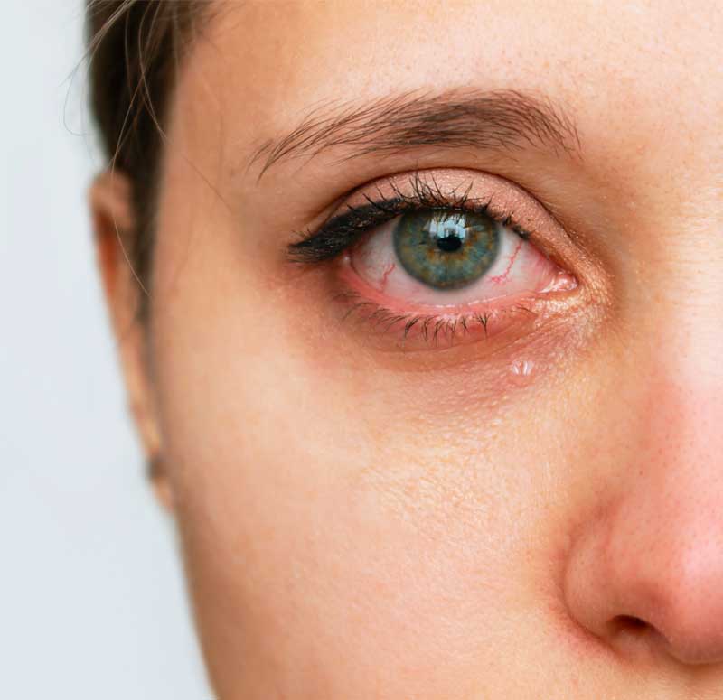 Retinopatia che cos'è: donna affetta da retinopatia